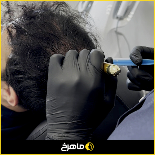 بهترین کلینیک مزوتراپی در گلستان
