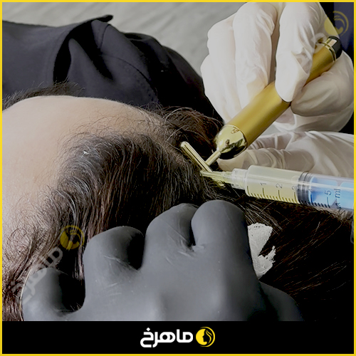 پی آر پی در کلینیک ماهرخ