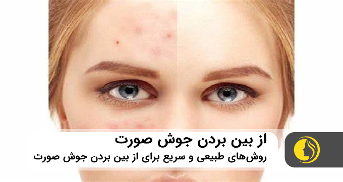 جوش صورت را تا شب یلدا از بین ببرید! 9 روش طبیعی و سریع