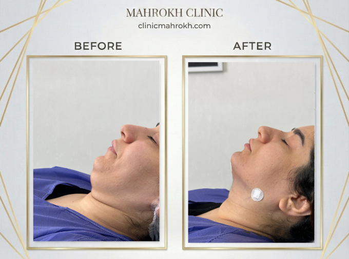 ویژگیهای بهترین دکتر ساکشن غبغب در اسلامشهر