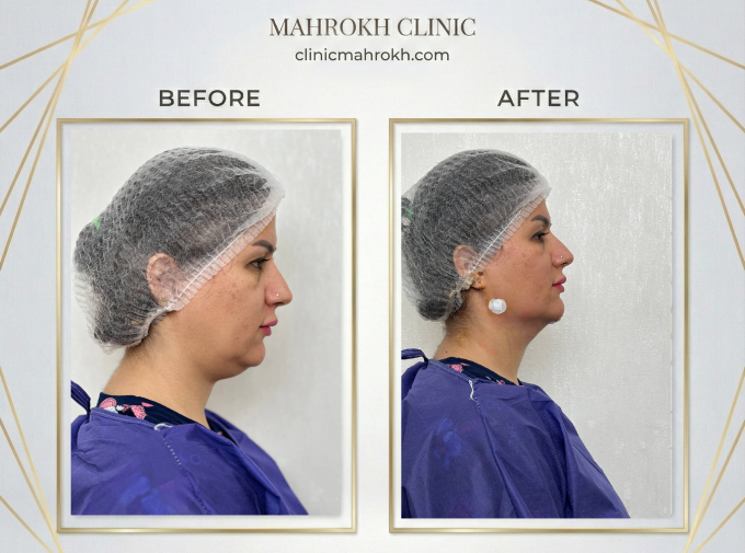 اقدامات قبل از مراجعه به بهترین دکتر ساکشن غبغب در اسلامشهر