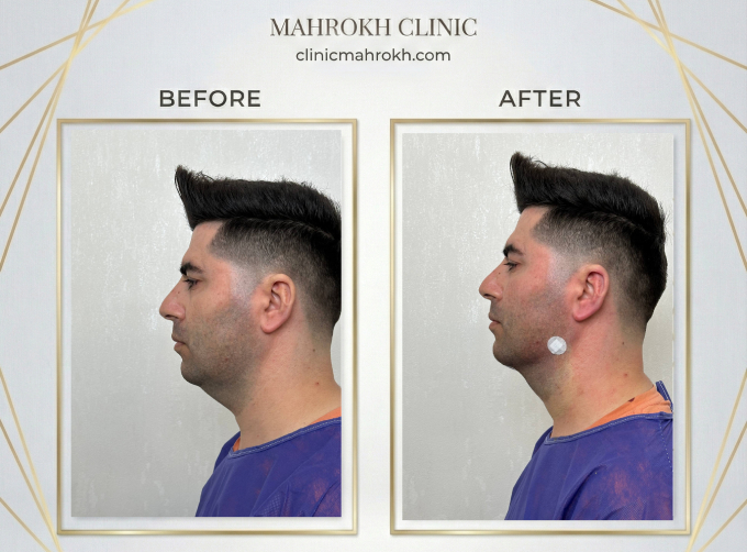 کاهش غبغب بدون جراحی با هایفوتراپی