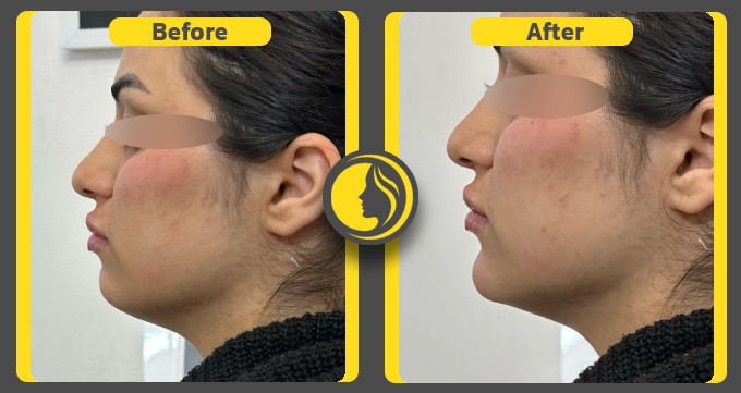 بهترین دکتر هایفوتراپی صورت در واوان