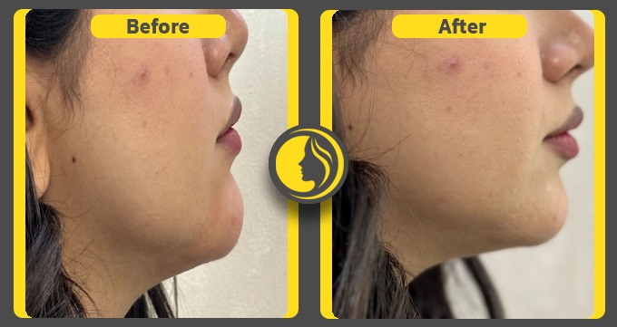 نمونه کار بوکال فت در کلینیک ماهرخ