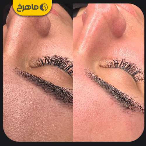 کربوکسی تراپی در کلینیک ماهرخ