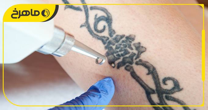 راهنمای مراقبت از پوست بعد از پاک کردن تاتو