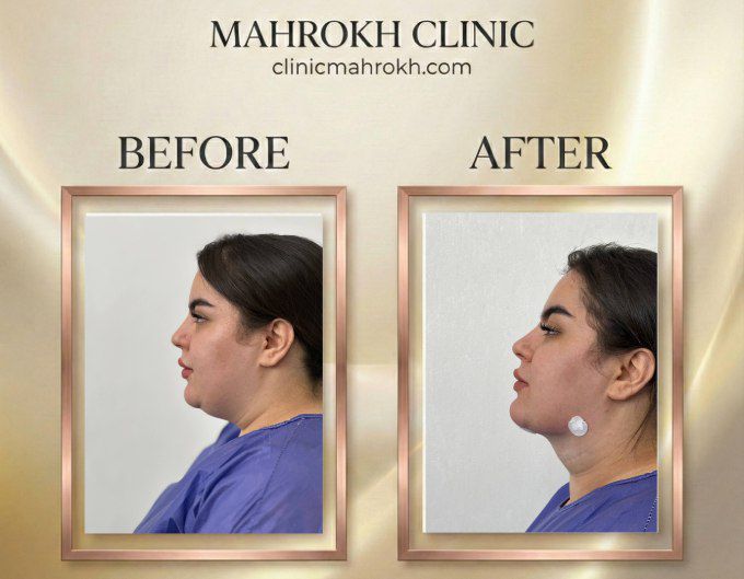 نمونه کار ساکشن غبغب (1)