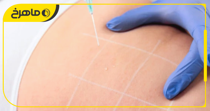 راه های افزایش ماندگاری تزریق فیلر بادی