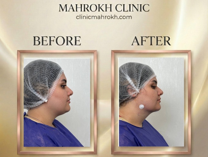 نمونه کار ساکشن غبغب