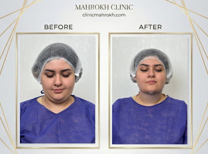 نمونه کار ساکشن غبغب