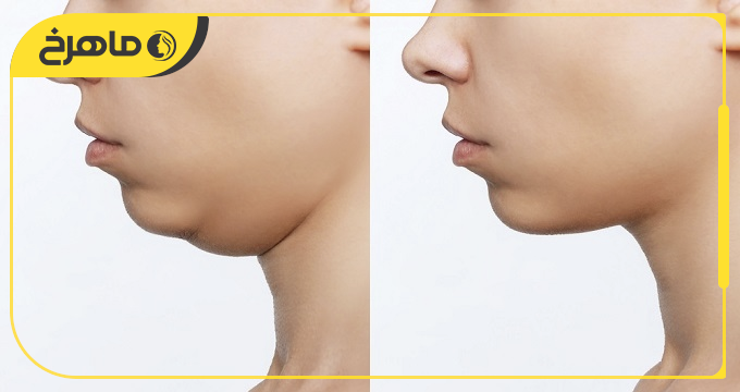 ساکشن غبغب در اندیشه برای چه افرادی مناسب است؟