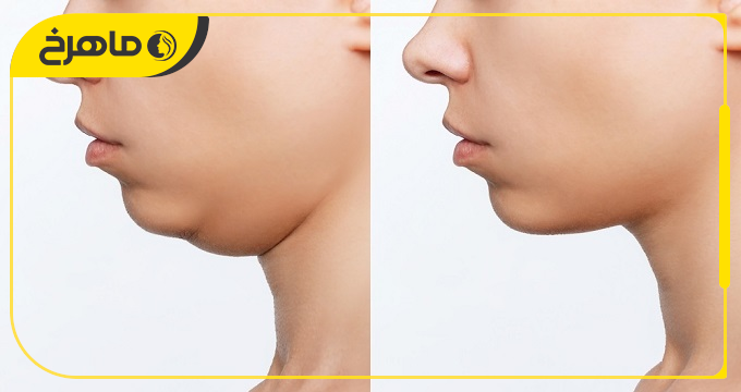 چگونه بهترین دکتر ساکشن غبغب در خانی آباد را انتخاب کنیم؟