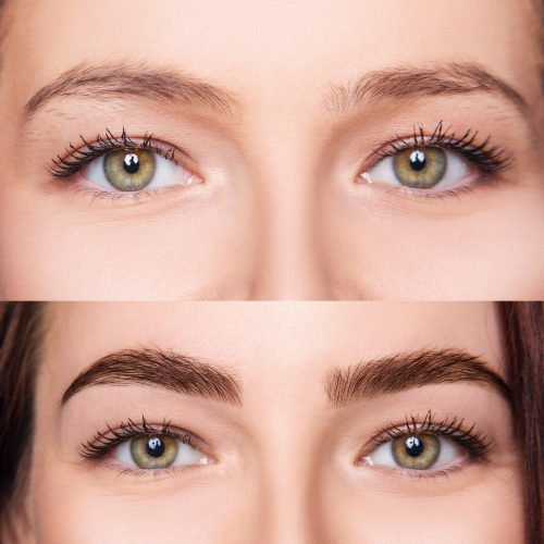 oparations-eyebrow-transplant-1